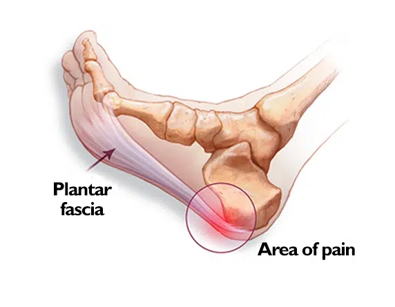 heel-spurs/